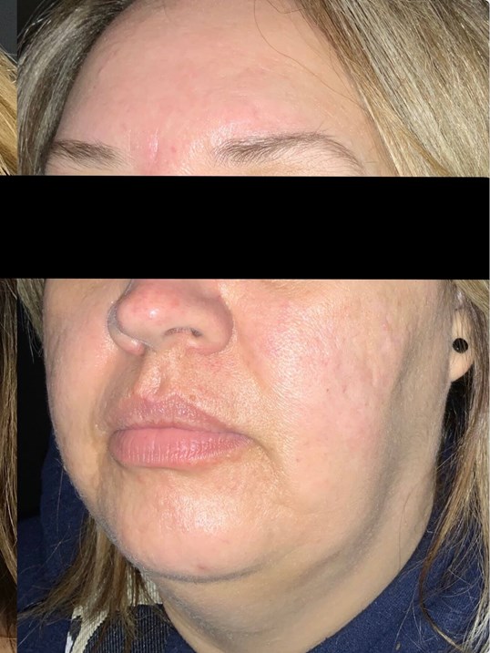 Micro-needling before and after pictures - Boston, MA